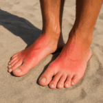 Zwei gebräunte Füße mit deutlich sichtbarem Sonnenbrand auf den Spannflächen, während sie auf einem Handtuch am Strand ruhen.